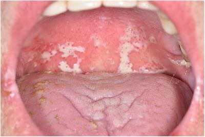 Oral infections in oral cancer survivors: A mini-review